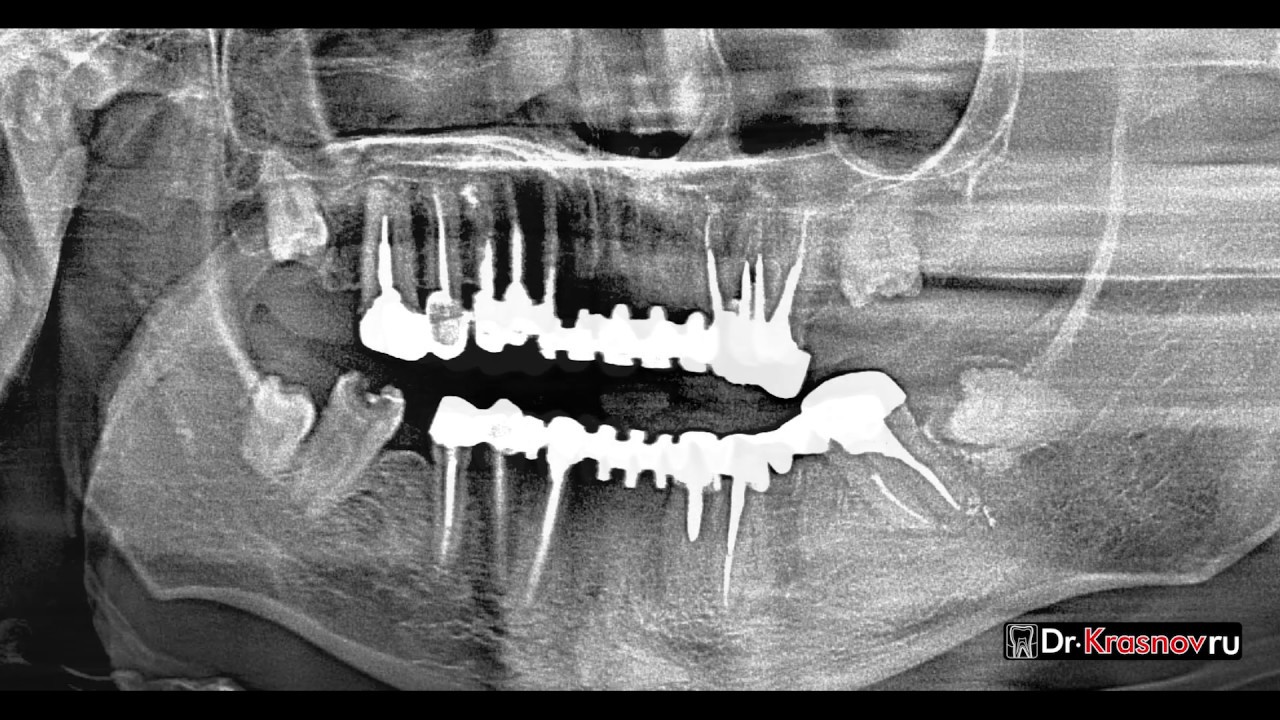 Расшифровка панорамного снимка зубов с фото