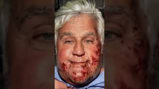 Jay Leno shows off his new ear after accident