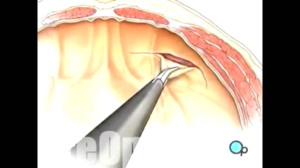 Hérnia Inguinal Cirurgia Por Videolaparoscopia Youtube 3230