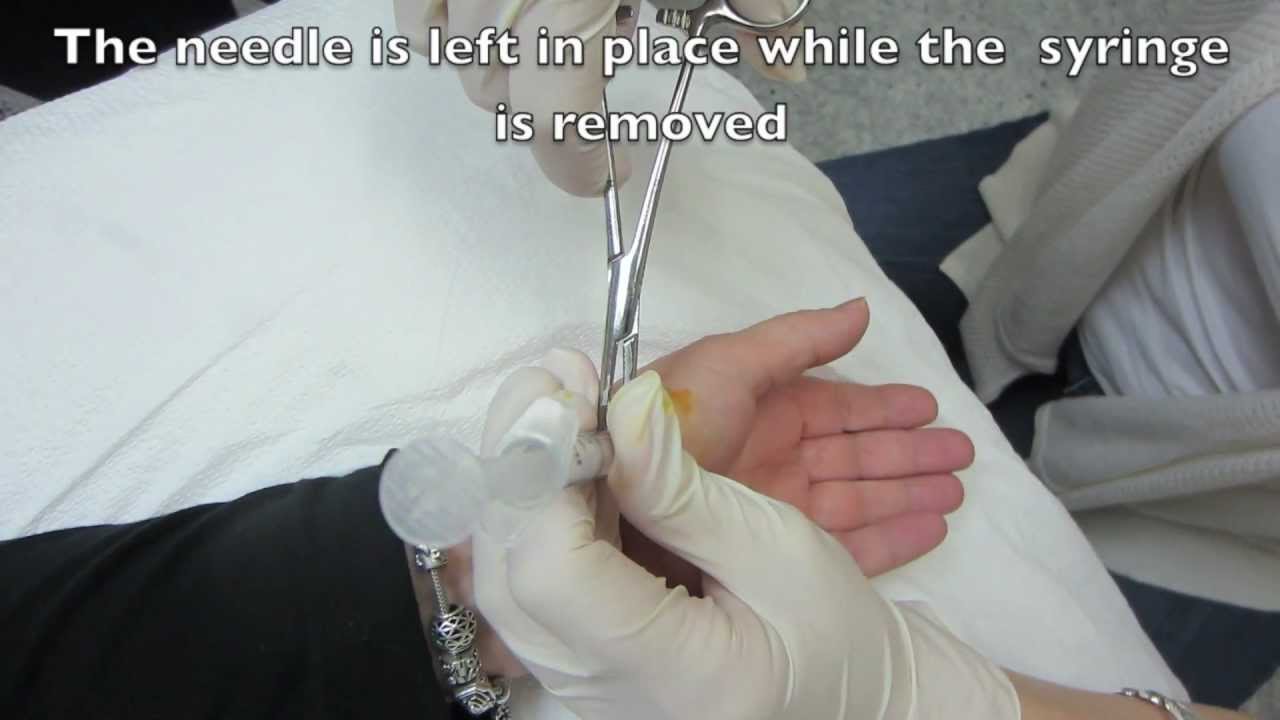 Mcp Injection Of The Left Thumb Metacarpophalangeal Joint Youtube 0289