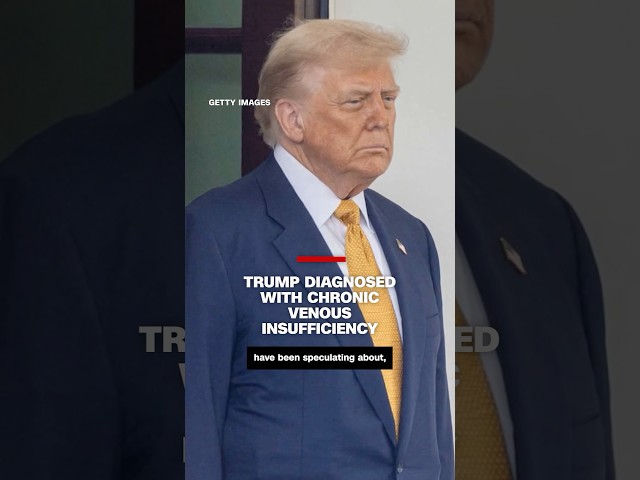 Trump diagnosed with chronic venous insufficiency