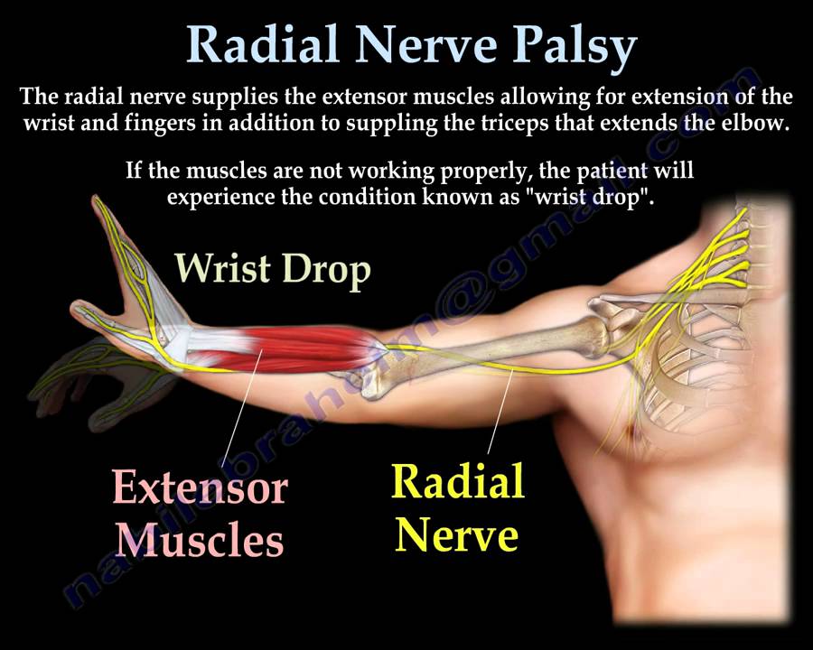 Radial Nerve Palsy, injury - WRIST DROP . Everything You ... unit cell diagram 