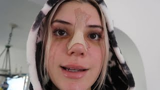 my nose surgery