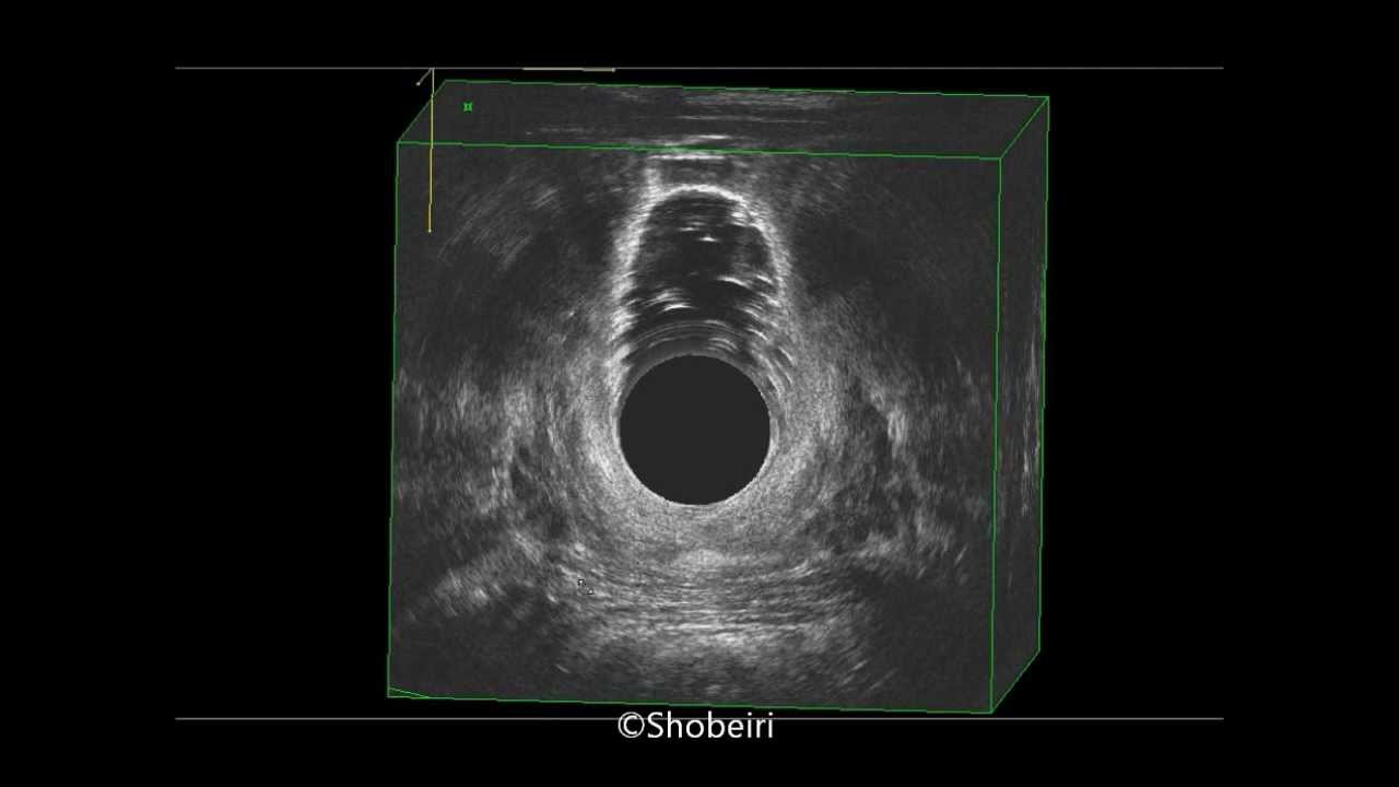 Endovaginal Ultrasound Pictures 83
