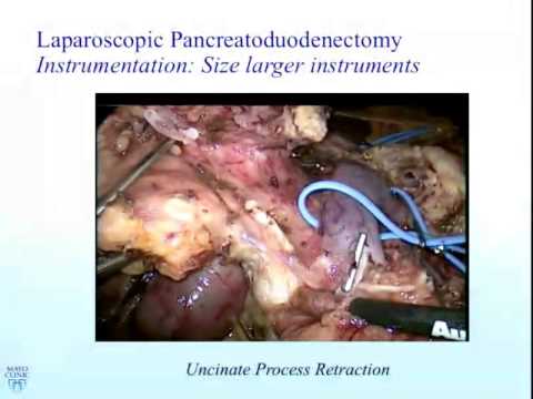 Technical tips for starters in laparoscopic pancreatectomy 