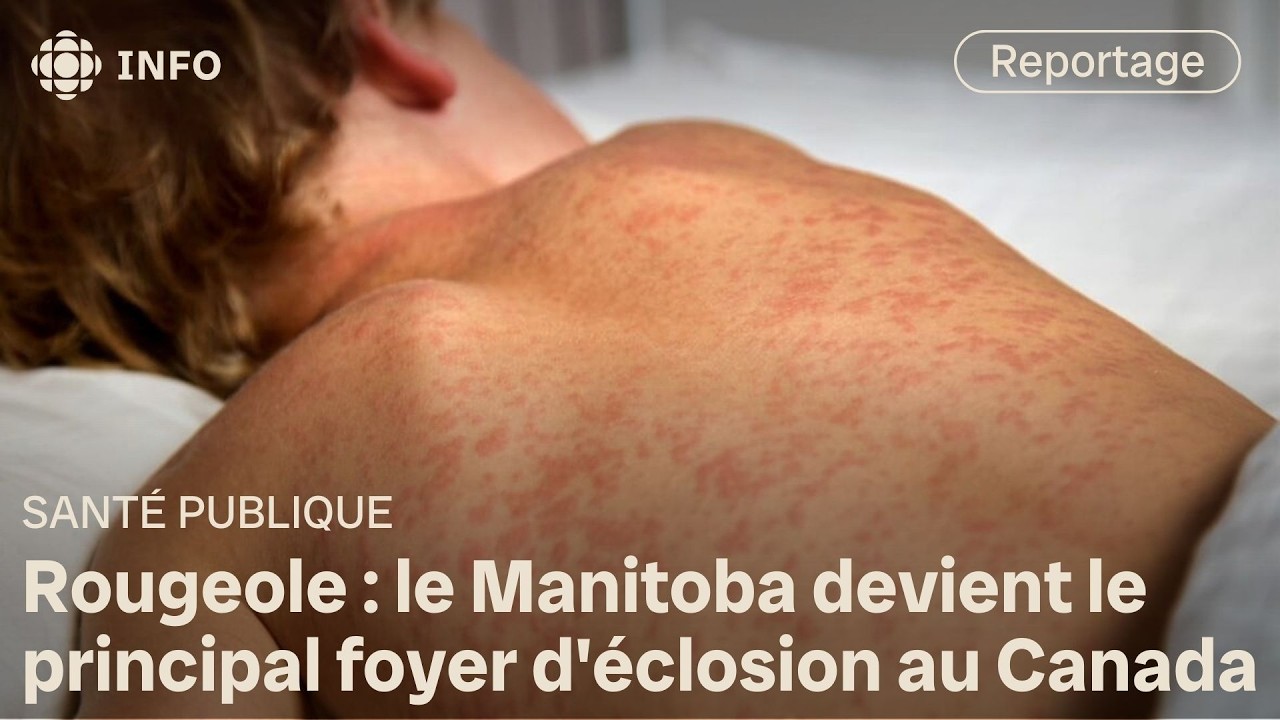 Le Manitoba connaît la pire éclosion de rougeole au Canada