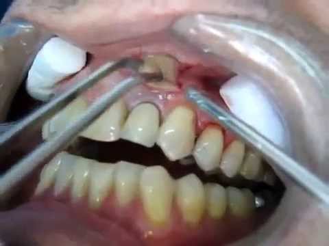 Un Dentiste perce un Abcès Dentaire oO ! Attention aux âmes sensibles ...