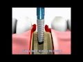 Implantul dentar