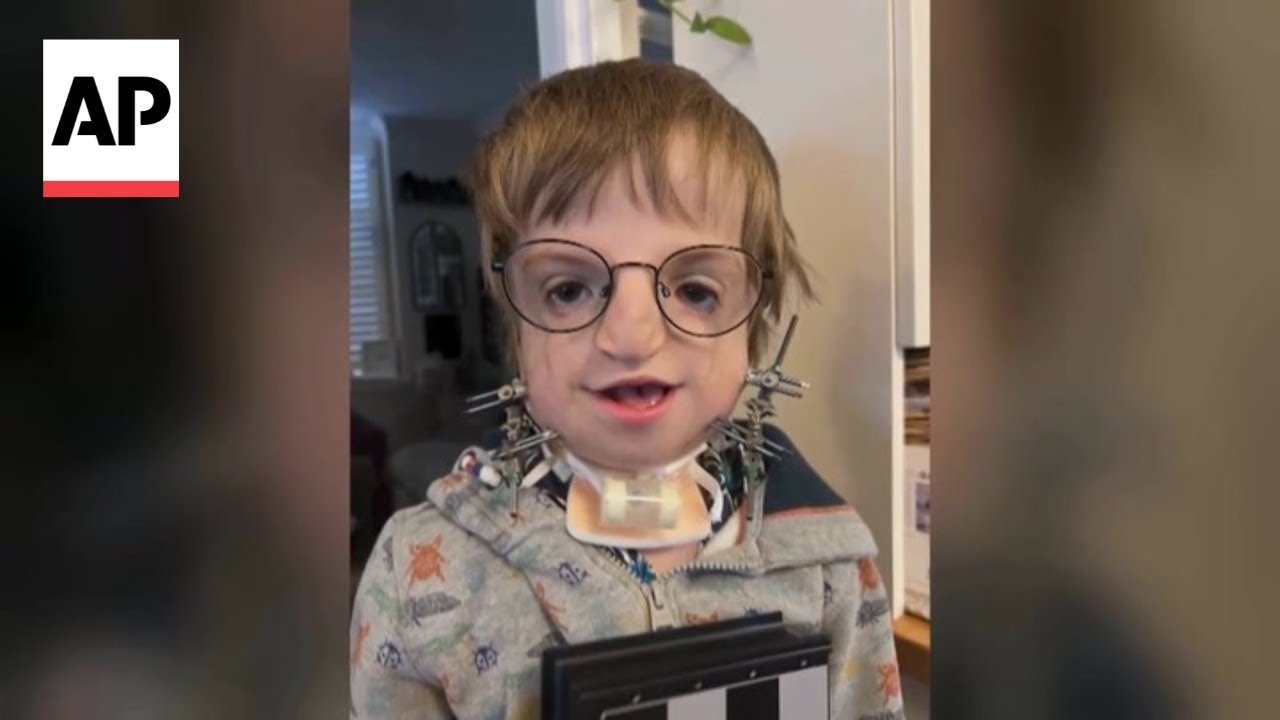Surgeons rebuild 7-year-old boy's jaw using his own ribs
