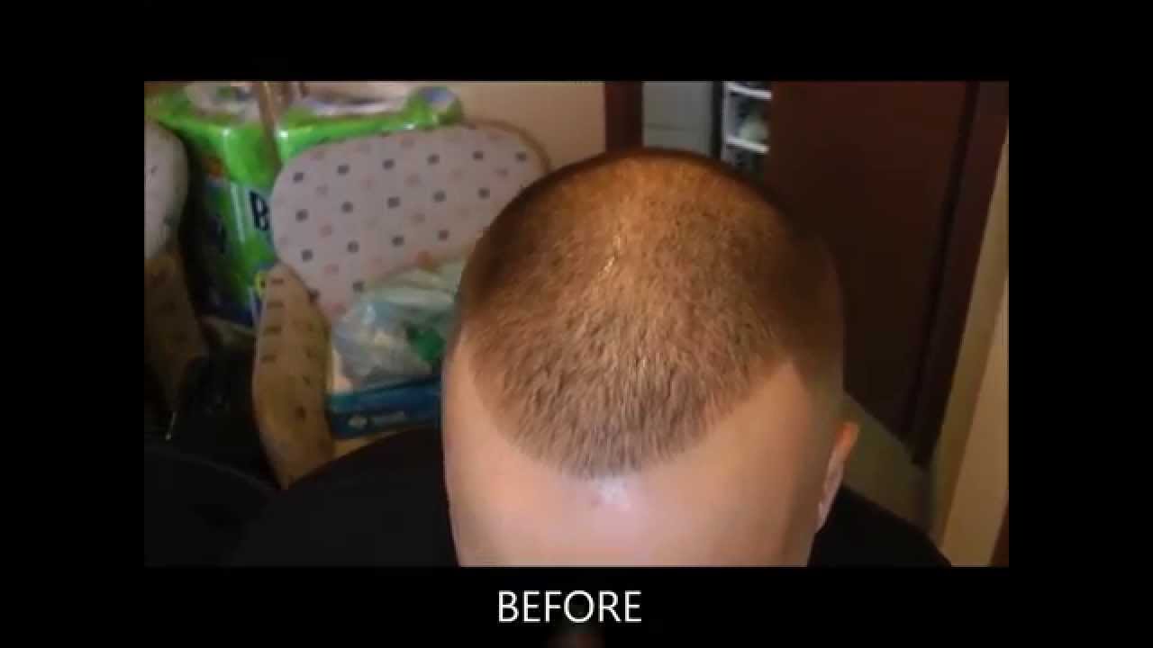 Hair Transplant Shaved Head 112