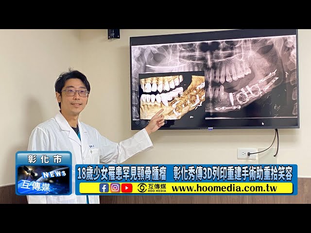 影／18歲少女罹患罕見顎骨腫瘤 彰化秀傳3D列印重建手術助重拾笑容