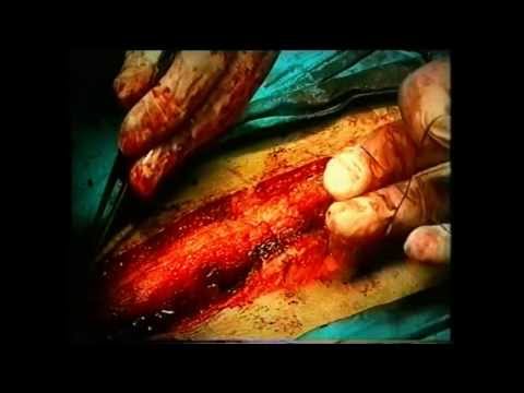 Microchirurgia ernia del disco