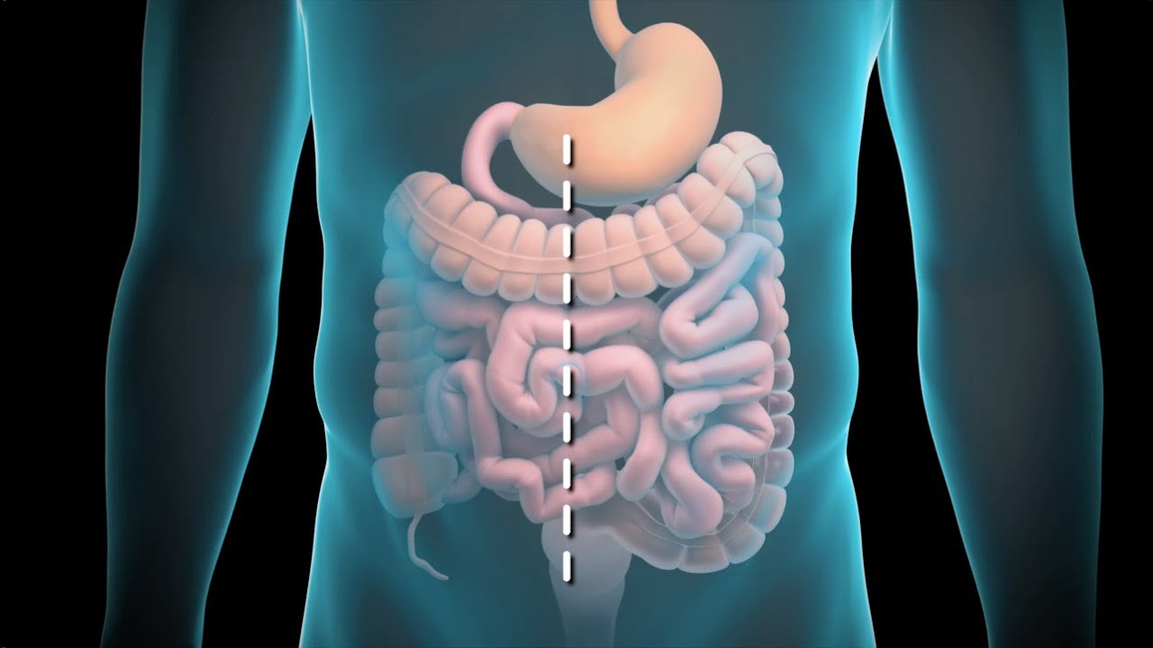 Colon Resection YouTube