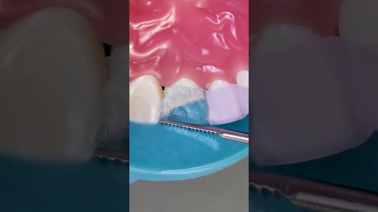 Why Is Anything Dental So Expensive? 🦷 Watch How Do They Fix a Chipped Tooth