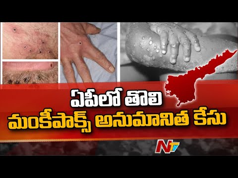 Suspected monkeypox case reported in Guntur