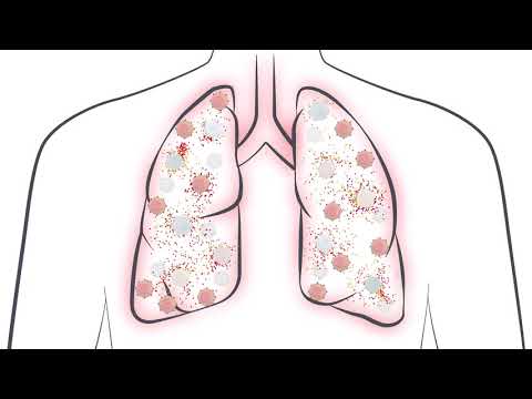 What is a Cytokine Storm and How Does it Impact COVID-19 Patients? What is a Cytokine Storm and How Does it Impact COVID-19 Patients?