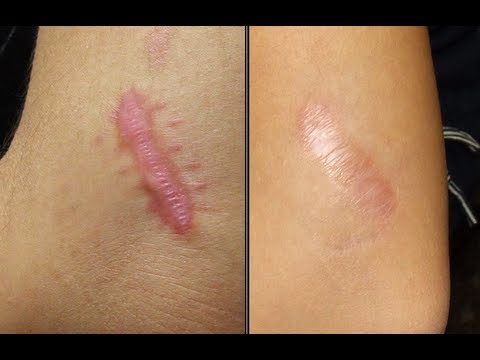 hypertrophic acne scarring #10