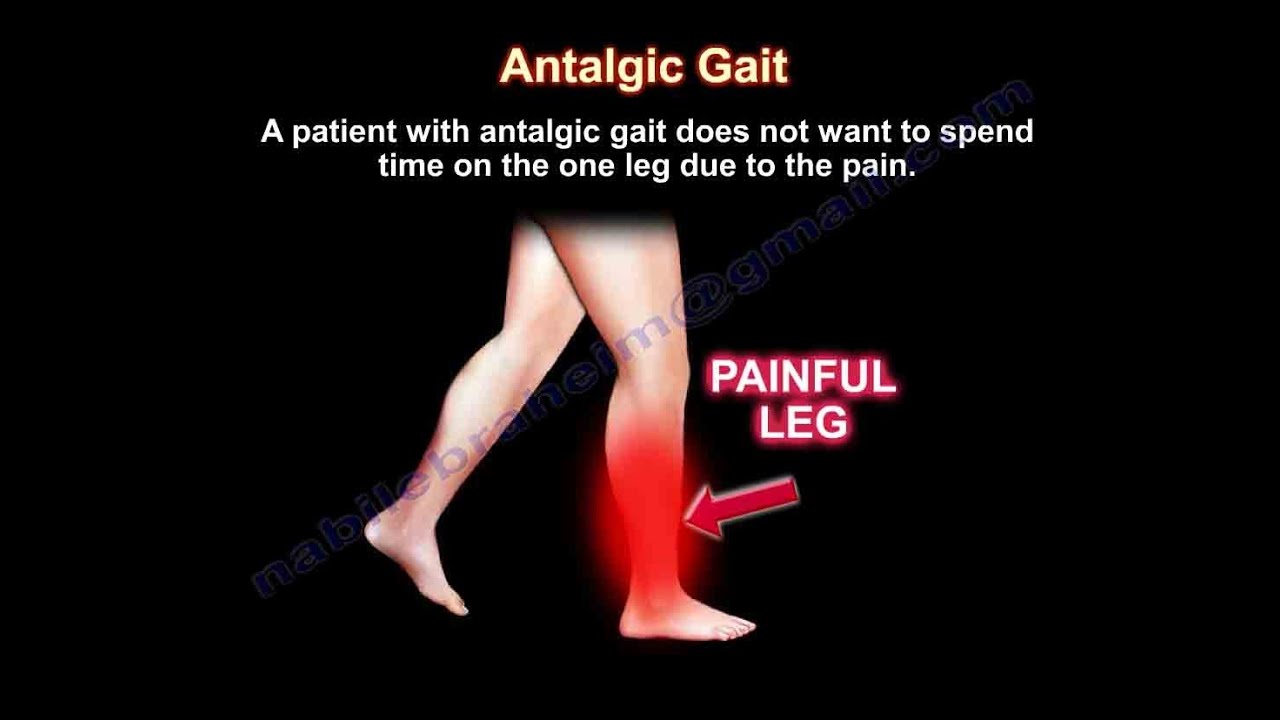 antalgic-gait-everything-you-need-to-know-dr-nabil-ebraheim-youtube