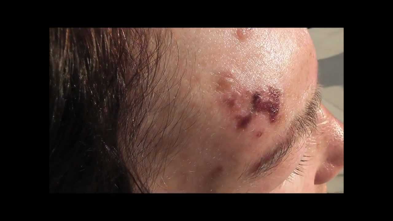 shingles-herpes-zoster-on-a-patient-s-forehead-before-and-during