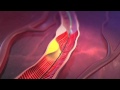 LipiScan Coronary Imaging System LipiScan Coronary Imaging System