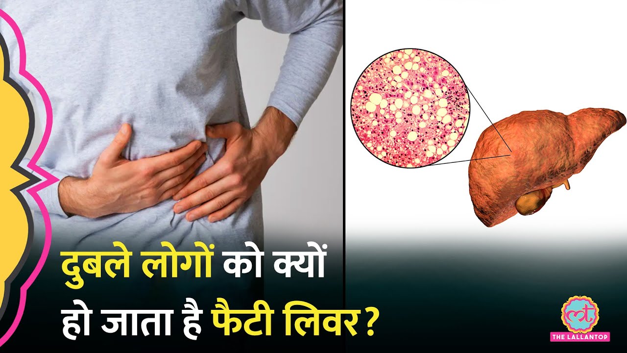 Fatty Liver सिर्फ Overweight व्यक्ति को ही नहीं, दुबले लोगों को भी हो सकता है | NAFLD