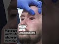 Man receives world’s first whole eye transplant after high-voltage electrical accident  - 00:45 min - News - Video