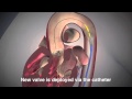 TAVR heart procedure for inoperable aortic stenosis TAVR heart procedure for inoperable aortic stenosis