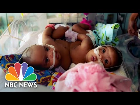 Conjoined twins separated in miracle procedure