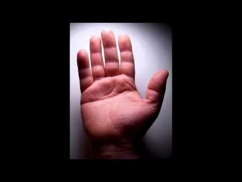 Simian Crease - Single transverse palmar crease (Down Syndrome) - YouTube