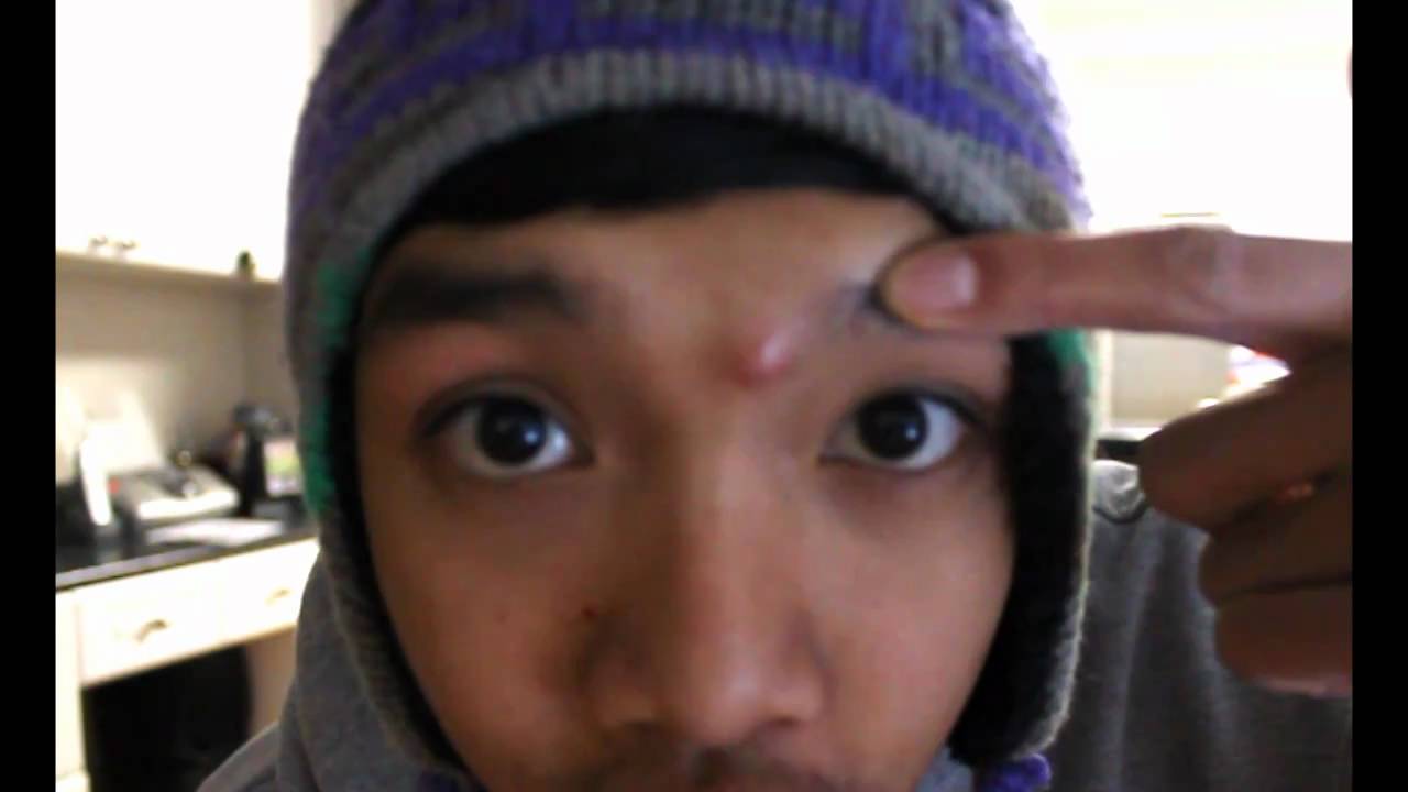 huge-zit-on-forehead-youtube