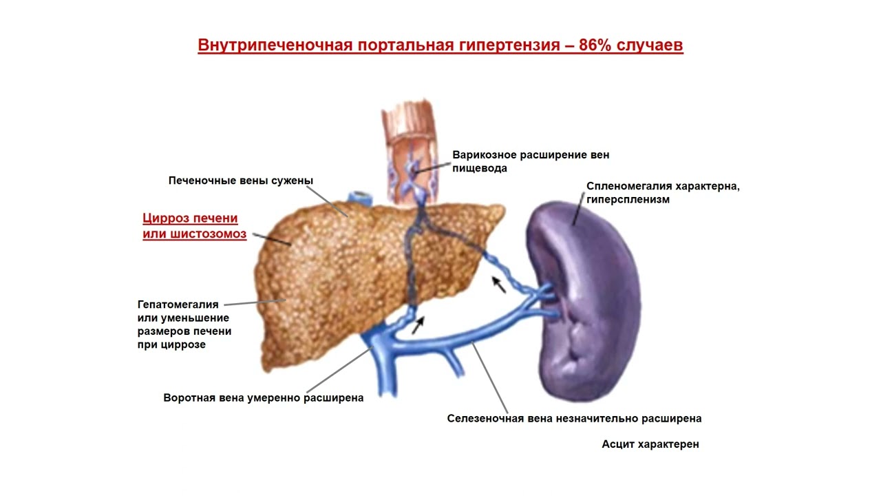 Портальная гипертензия план обследования