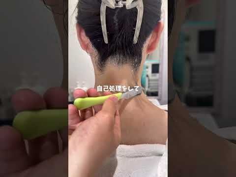 高校生でも大丈夫です🙆‍♂️ #うなじ脱毛