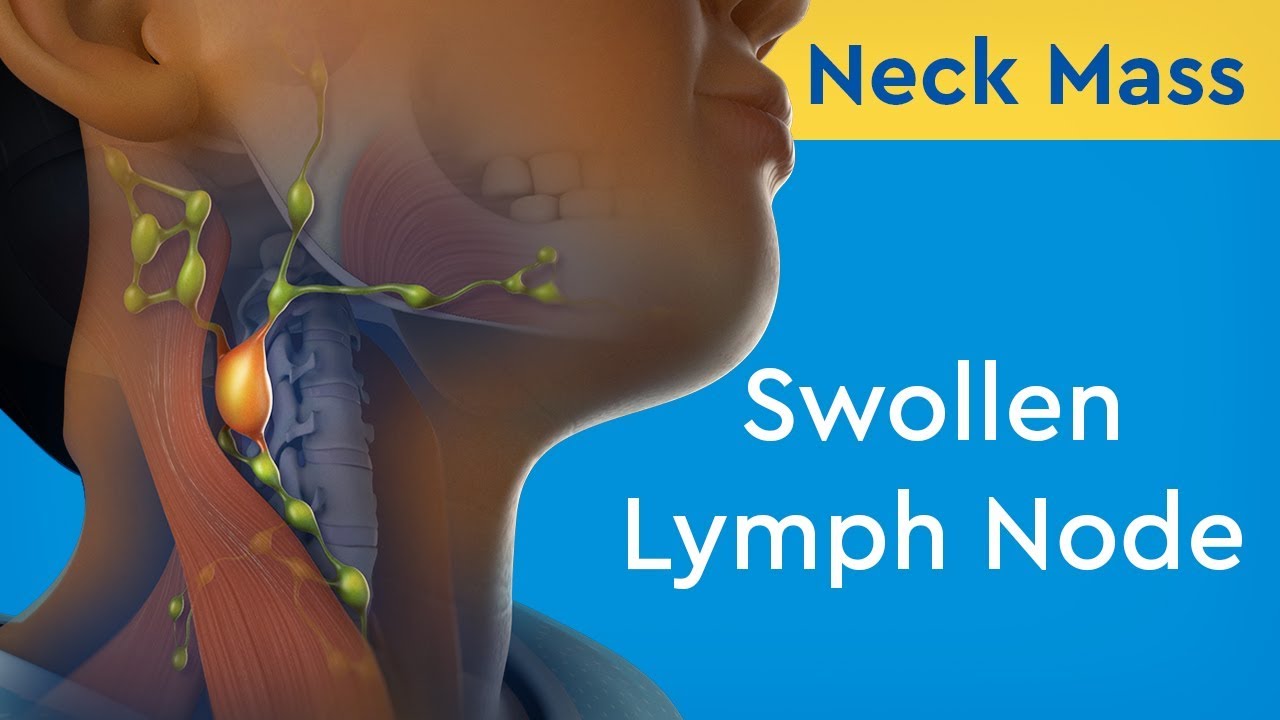 Swollen Lymph Nodes Children s Hospital Colorado