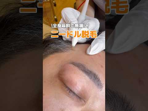 全身麻酔で無痛ニードル脱毛！ #脱毛 #ニードル脱毛 #全身麻酔 #shorts