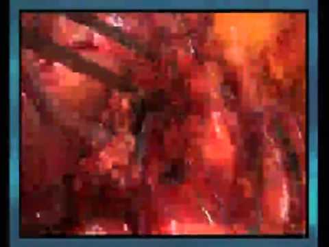 Central pancreatectomy: surgical differences between open and laparoscopic approaches 