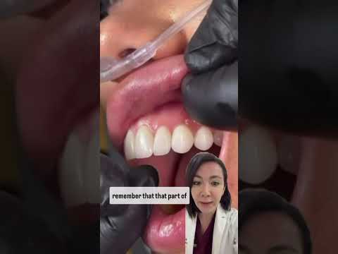 Risks Of Getting Veneers Done!