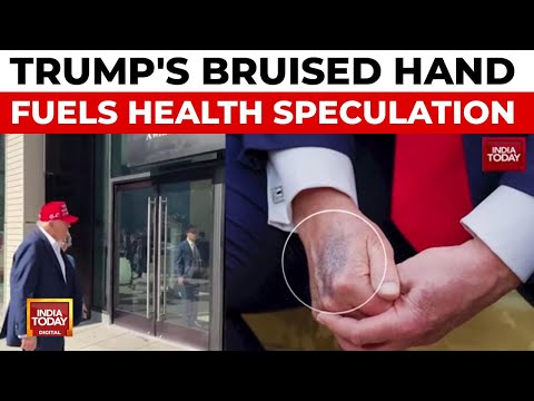 Donald Trump's Bruised Hand Sparks Health Scare; White House Cites Common Condition | India Today
