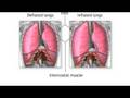 Lung Cancer Development