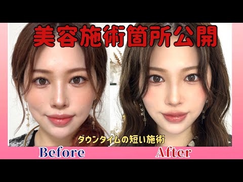 【美容整形】最近顔が垢抜けた理由を教えます‼️