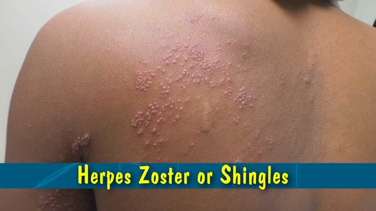 herpes zoster rash
