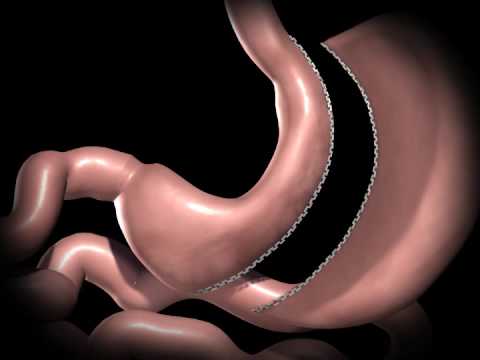 Sleeve Gastrectomy Animation