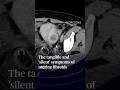 The tangible and silent symptoms of uterine fibroids