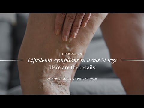 Lipedema symptoms in the arms & legs. Here are the details | Amaris B. Clinic by Dr Ivan Puah