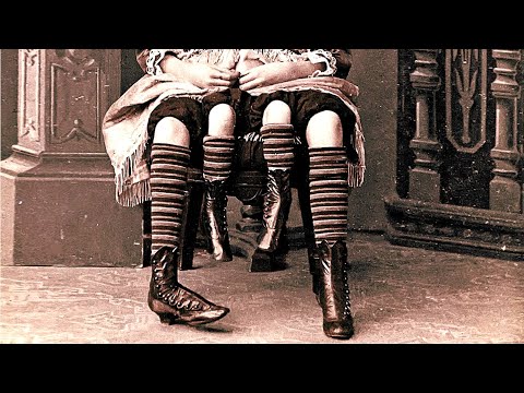 Неверојатната приказна на Миртл Корбин - девојчето родено со 4 нозе