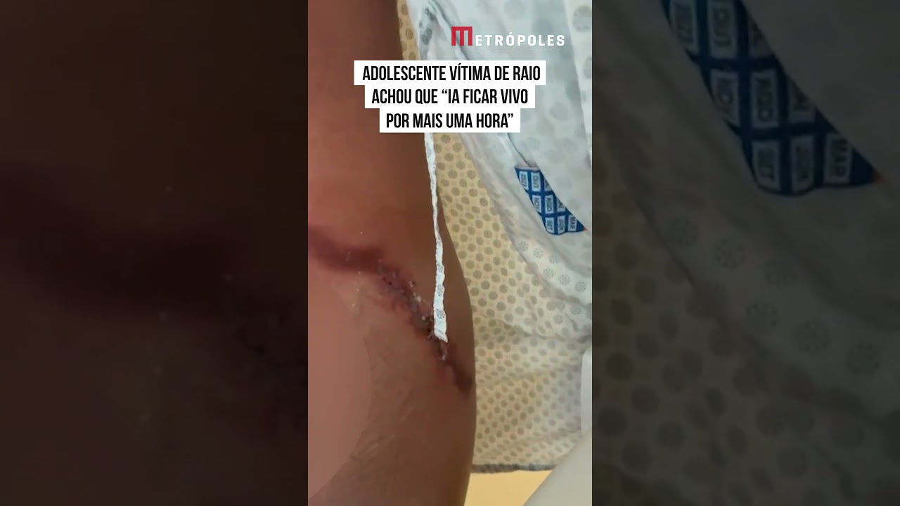 Adolescente vítima de raio achou que “ia ficar vivo por mais uma hora”