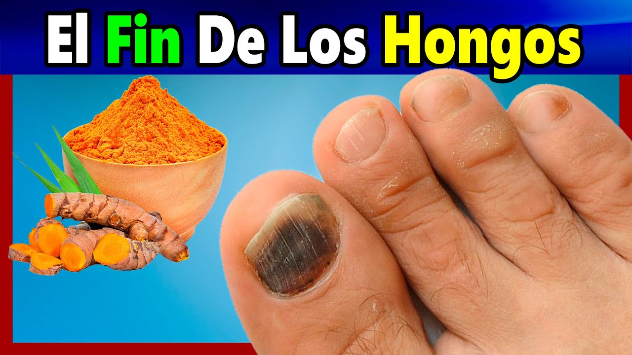 Que es bueno para los hongos de los pies