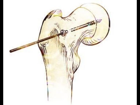Percutaneous  Cannulated Screw Fixation  of Slipped Capital Femoral Epiphysis