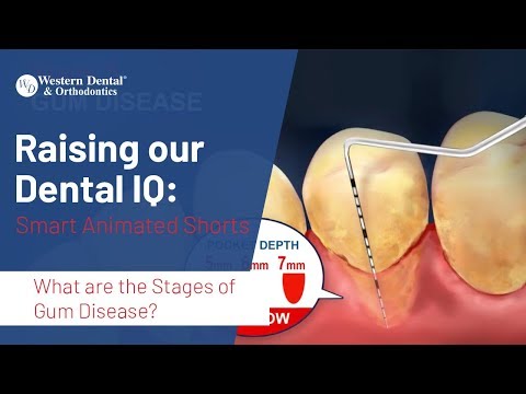Stages of Periodontal Disease Stages of Periodontal Disease