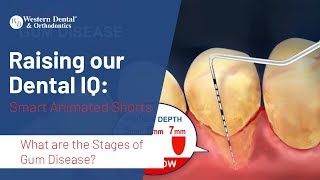 What are the Stages of Gum Disease? | Western Dental