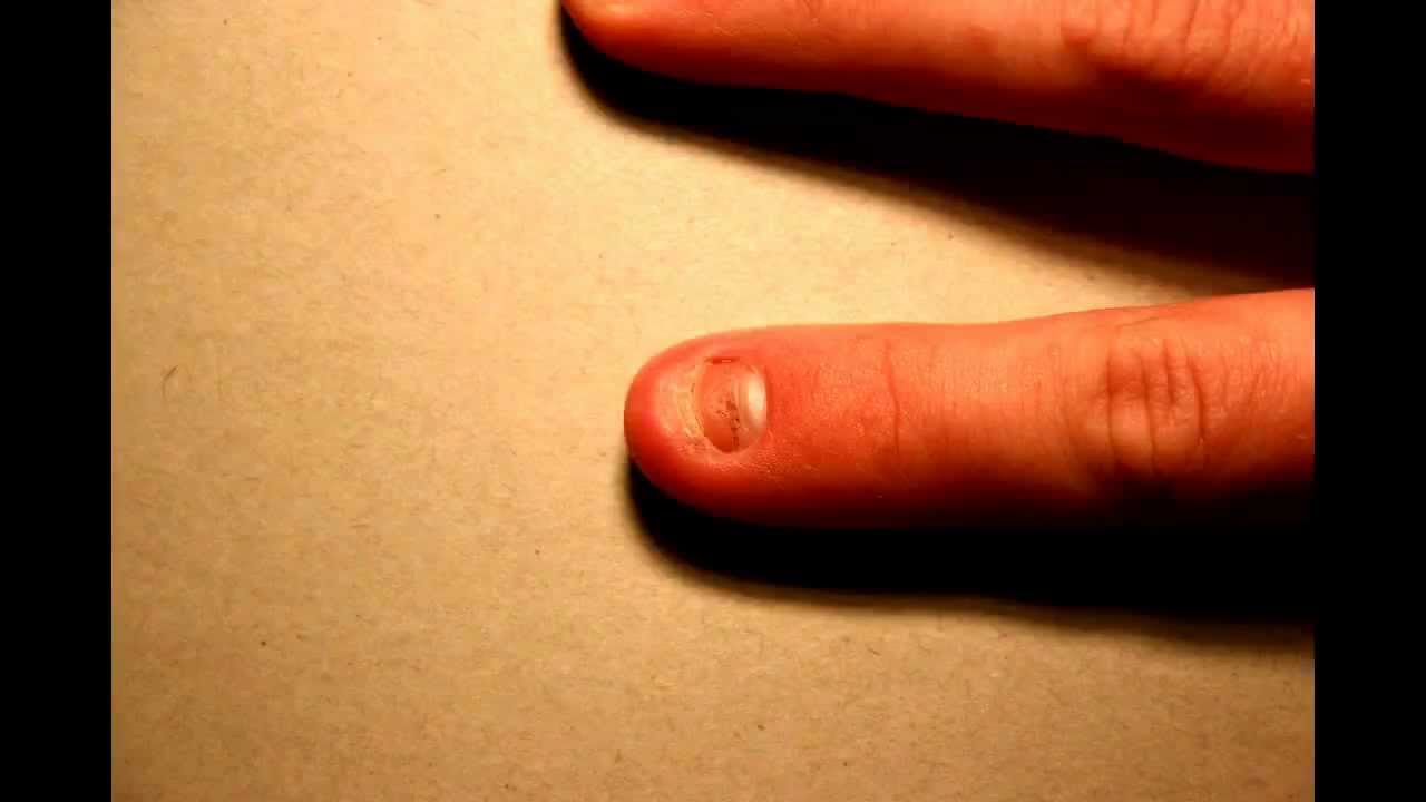 paronychia-causes-and-treatment-of-an-infected-nail